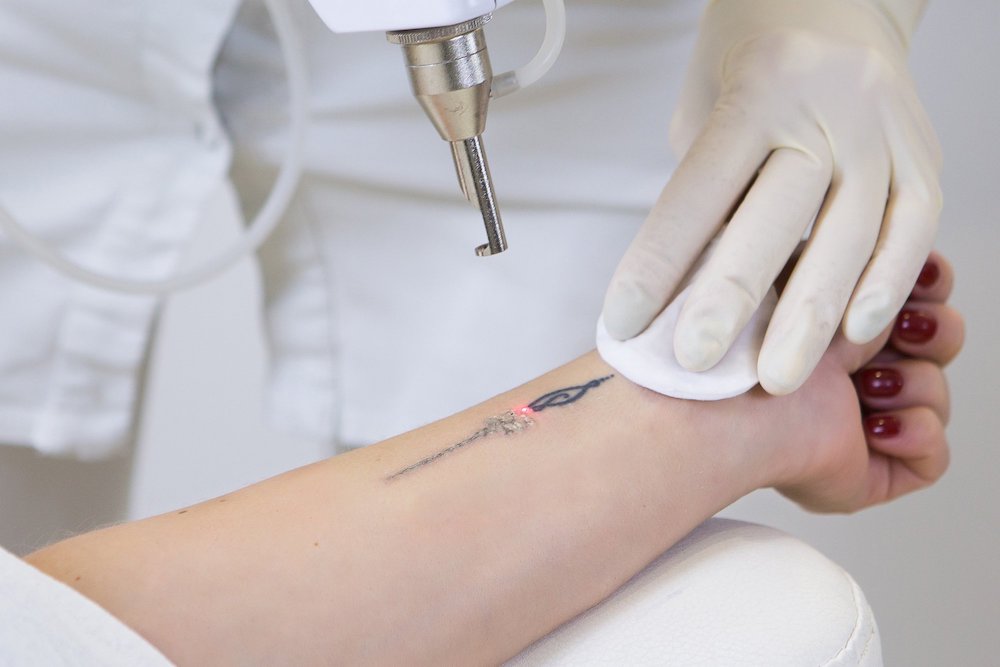 Laser Tattoo Removal After 4 Sessions