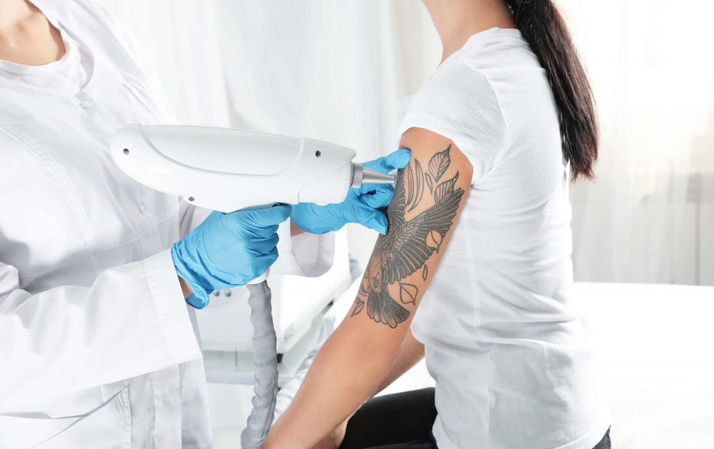 Tattoo regret can be painful. Here's what laser removal feels like. - The  Washington Post