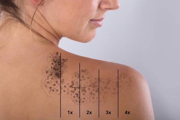Tattoo Removal Near Me Only The Best Specialists MedSpa