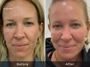 Microneedling​ before and after