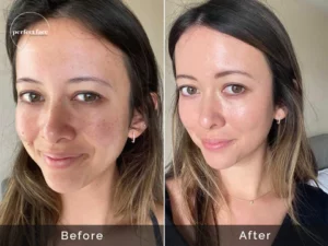 Microneedling​ before and after